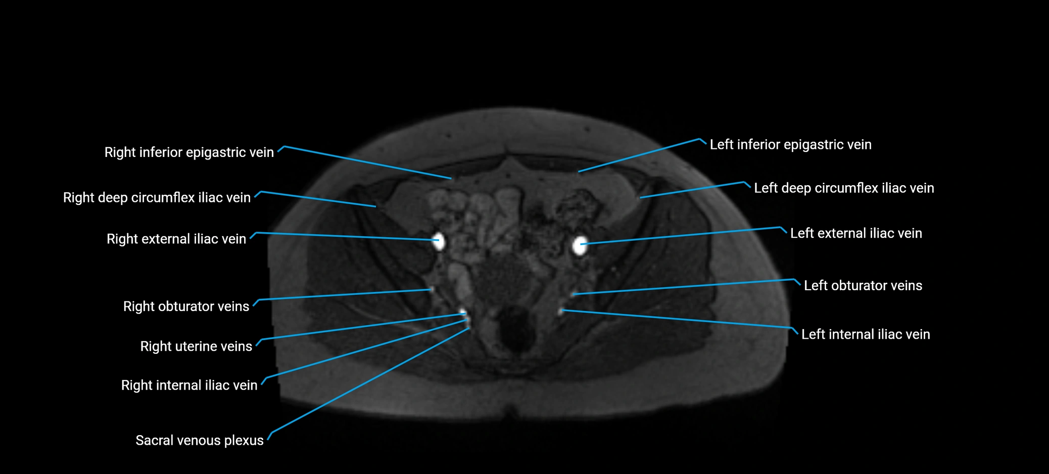 MRV abdomen pelvis & lower limb axial cross sectional anatomy labelled MRI image 154 (1).webp